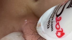 Выдавливание прыщей, угрей, черных точек и камедонов #19