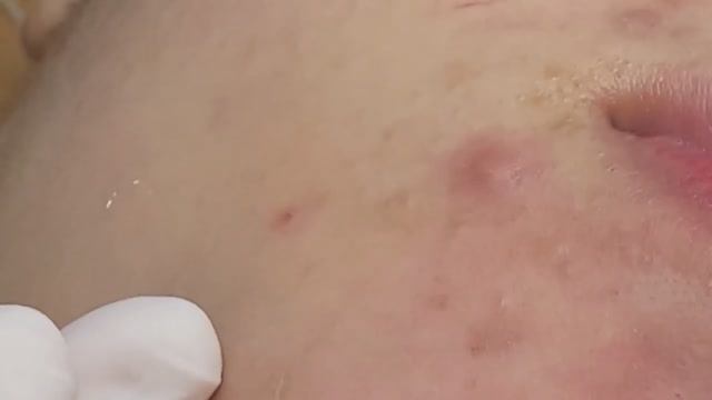 Убирание красных и болезненных прыщей. #прыщи #угри смотреть онлайн