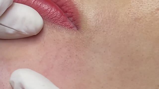 Лечение черных точек и белых угрей: эффективный метод смотреть онлайн