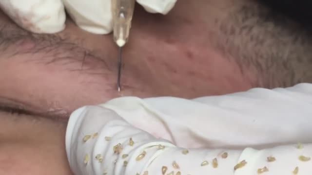 Устранение подкожных прыщей, черных точек и воспаленных угрей смотреть онлайн