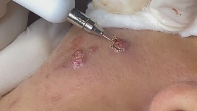 Огромные бородавки на щеке. Удаление. смотреть онлайн