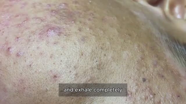 Профессиональное очищение кожи от комедонов. Техника #𝟗𝟎520 смотреть онлайн