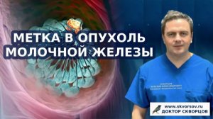 Метка в опухоль молочной железы (РМЖ)