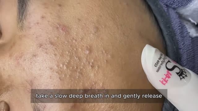 Чистим лицо от комедонов. Механический метод #𝟗𝟎523 смотреть онлайн