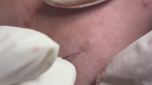 Лечение подкожных, воспалительных и кистозных прыщей смотреть онлайн