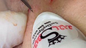 Выдавливание прыщей, угрей, черных точек и камедонов #21