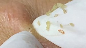 Выдавливание прыщей, угрей, черных точек и камедонов #23