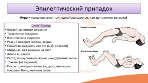 Лекция 6.3 Эпилепсия