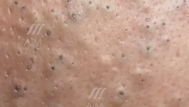 Расслабляющее удаление крупных кистозных угрей и черных точек смотреть онлайн