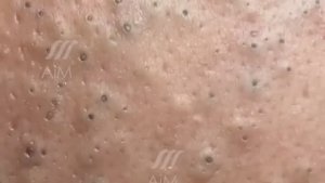 Расслабляющее удаление крупных кистозных угрей и черных точек