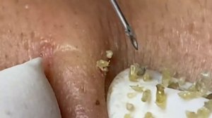 Выдавливание прыщей, угрей, черных точек и камедонов #24