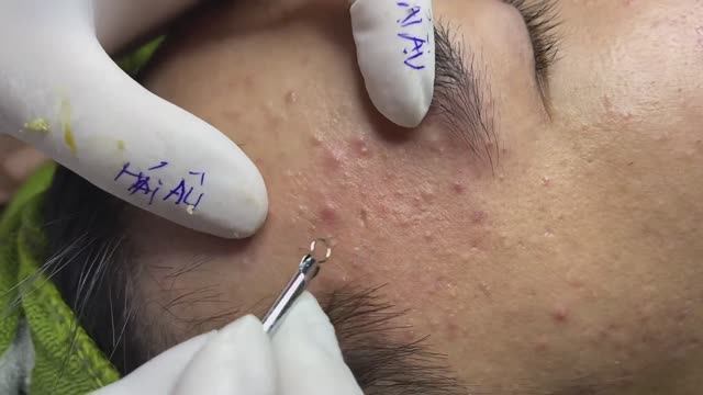 Прыщи / Акне в переходном возрасте. #акне #механическаячистка смотреть онлайн