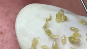 Выдавливание прыщей, угрей, черных точек и камедонов #25