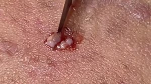 Выдавливание прыщей, угрей, черных точек и камедонов #27