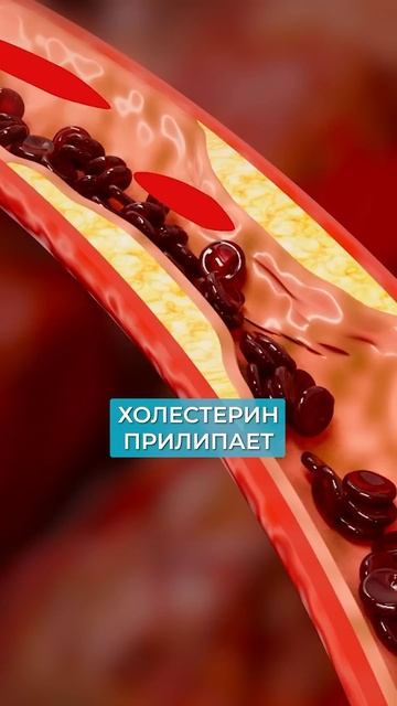 Из-за ЭТОГО ЛЕГКО будет ИНСУЛЬТ! #атеросклероз #инсульт #сосуды смотреть онлайн