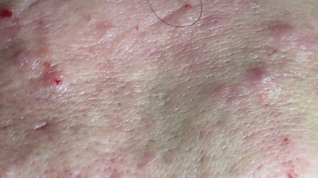 Лечение скрытых акне (комедонов). #комедоны #проблемнаякожа смотреть онлайн