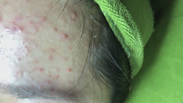 Прыщи (акне) у студентки из-за того, что мазала всякой ерундой. смотреть онлайн