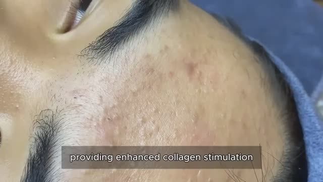 Asmr. Чистим кожу от черных точек. #𝟗𝟎536 #прыщи #угри #угреваясыпь смотреть онлайн