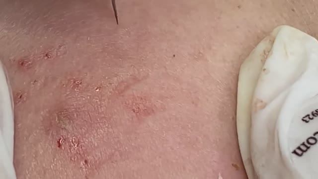 Акне / прыщи, скрытые глубоко под кожей смотреть онлайн