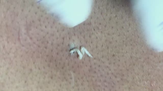 Профессиональное удаление акне #акне #постакне #механическаячистка смотреть онлайн