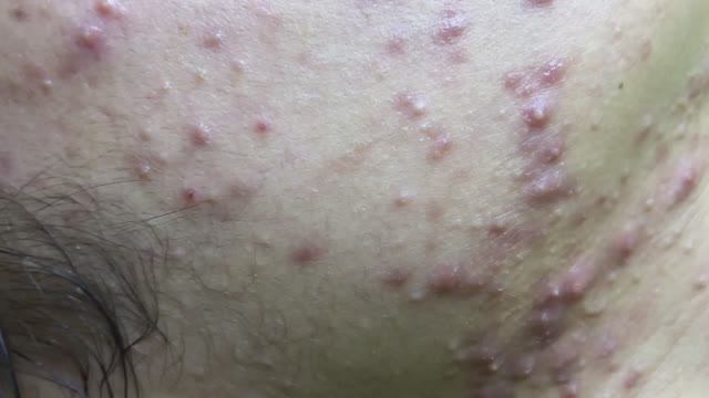 Asmr. Профессиональное избавление от черных точек. смотреть онлайн