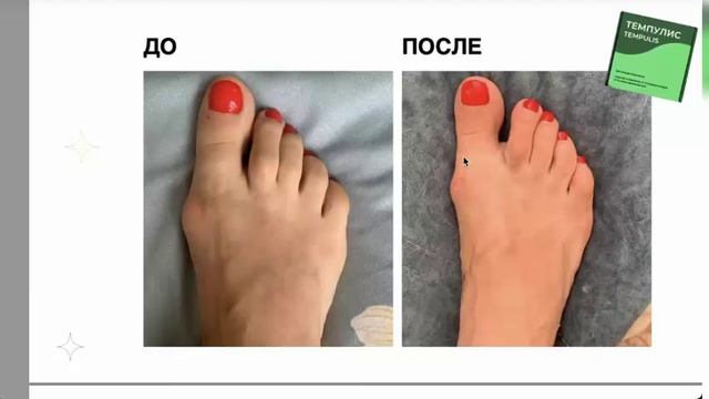 Темпулис. X-HEALF