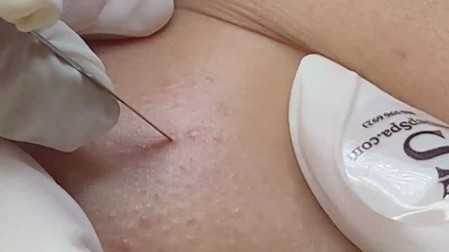 Глубокие подкожные прыщи. Механическое удаление смотреть онлайн