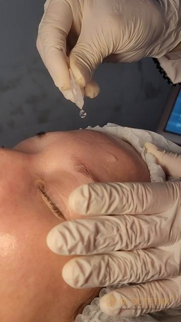 Карбоновых пилинг