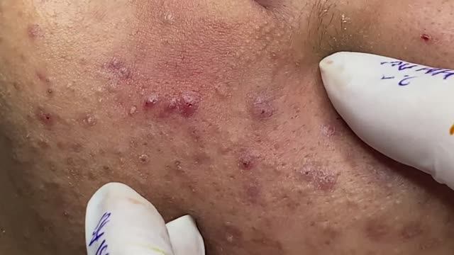 Лечение прыщей в 14 лет. Часть 4: невероятный результат смотреть онлайн