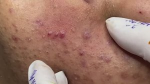 Лечение прыщей в 14 лет. Часть 4: невероятный результат