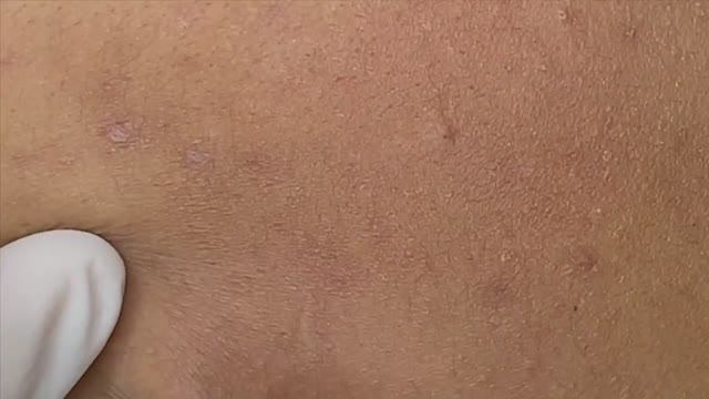Лечение акне на обгоревшей коже ｜ Treating Acne On Sunburned Skin смотреть онлайн