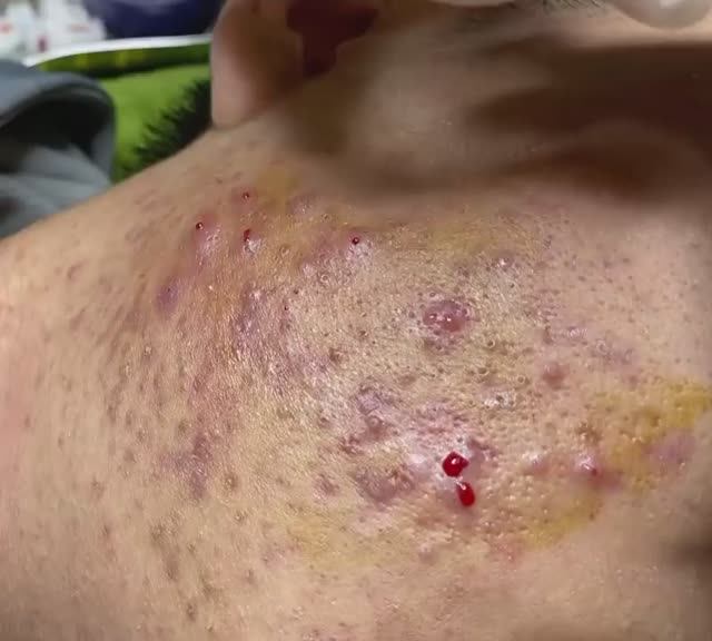 Лечение прыщей в 14 лет. Часть 6: невероятный результат смотреть онлайн