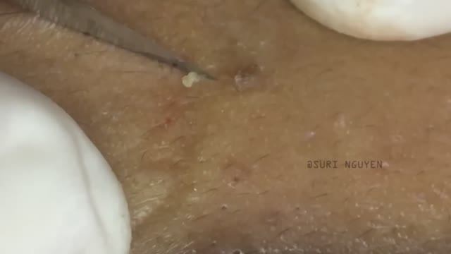 Удаление акне: эффективное лечение, которое работает. Suri Job 12 смотреть онлайн