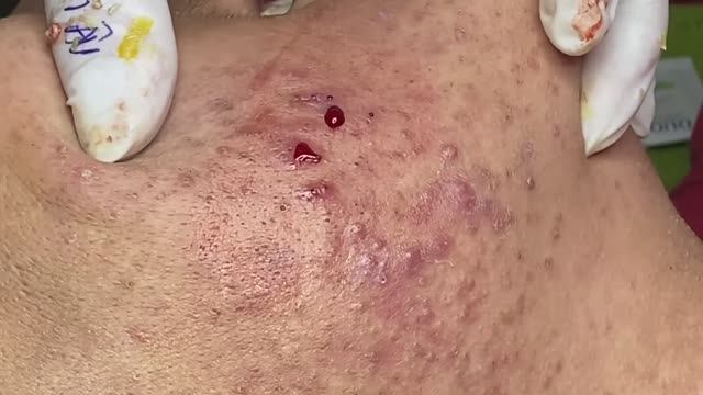 Лечение прыщей в 14 лет. Часть 2: невероятный результат смотреть онлайн