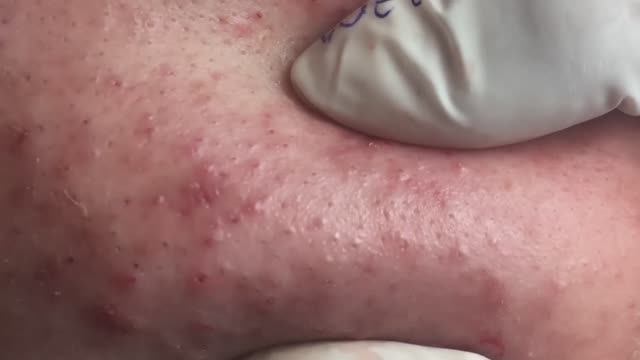 Лечение воспалительного акне для Мэй, часть 2, сессия 1 смотреть онлайн