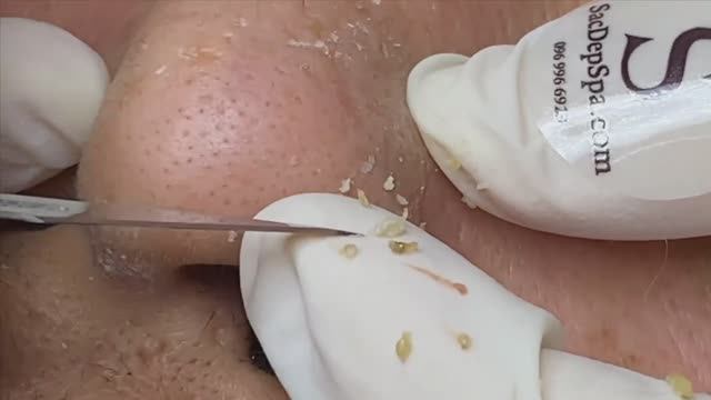 Удаляем въевшиеся черные точки с мужского лица | Remove Stubborn blackheads On Men's Skin смотреть онлайн
