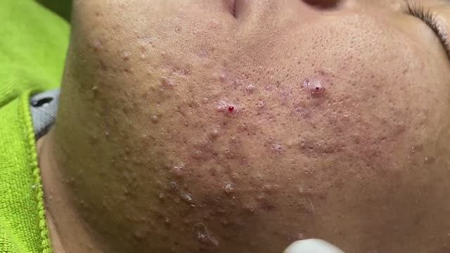 Лечение прыщей в 14 лет. Часть 5: невероятный результат смотреть онлайн