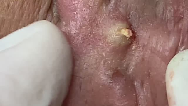 Прыщи за ушами. Устранение проблемы #прыщизаушами смотреть онлайн