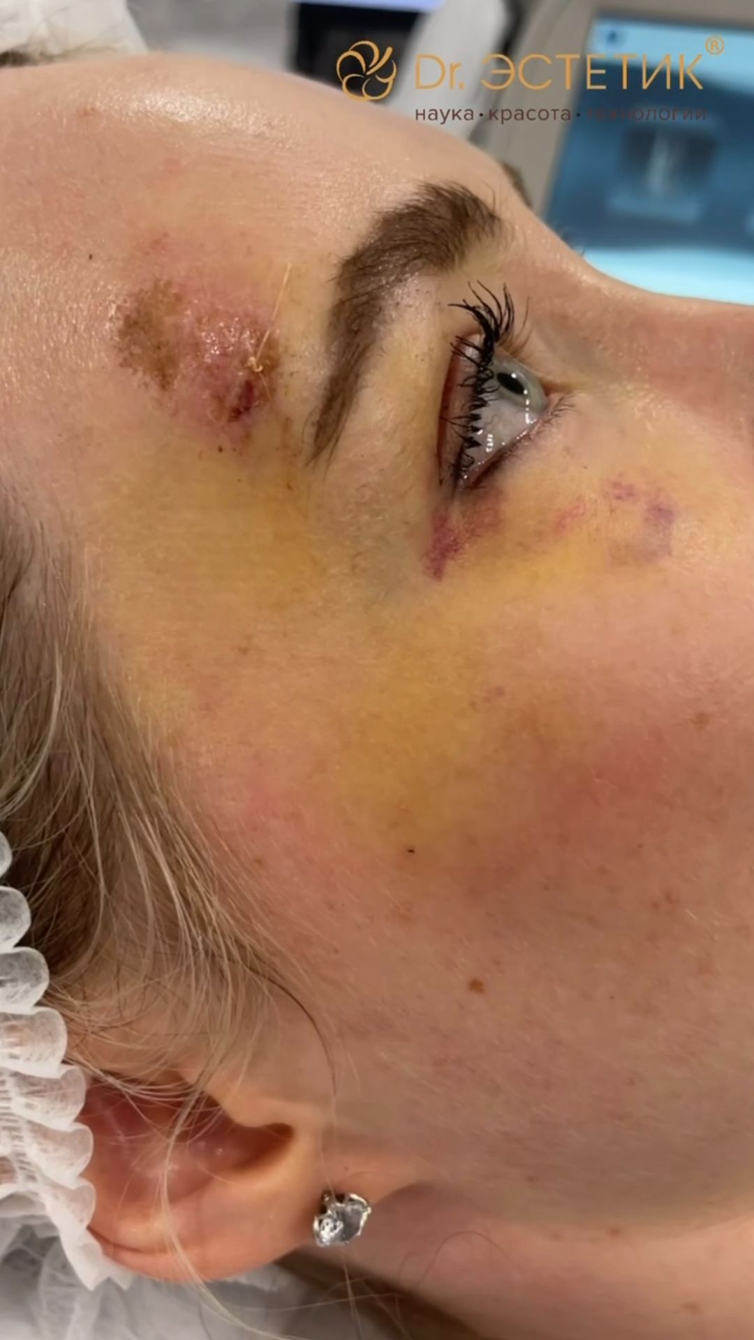 Что делать, если большая гематома?