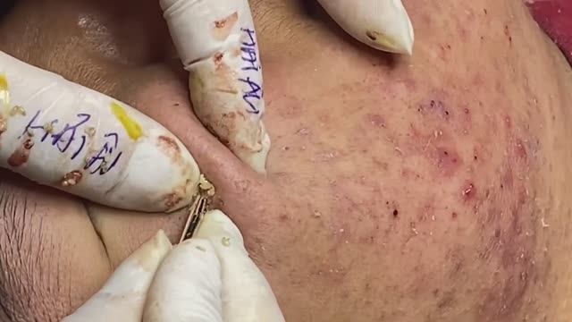 Лечение прыщей в 14 лет. Часть 3: невероятный результат смотреть онлайн