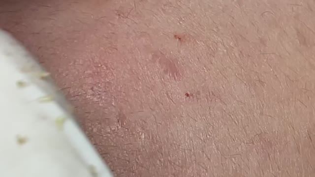 Удаление акне у молодой девушки #удалениеакне #механическаячистка смотреть онлайн