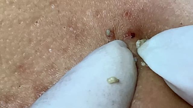 Гигантские черные точки: процесс удаления | Biggest blackheads removal смотреть онлайн