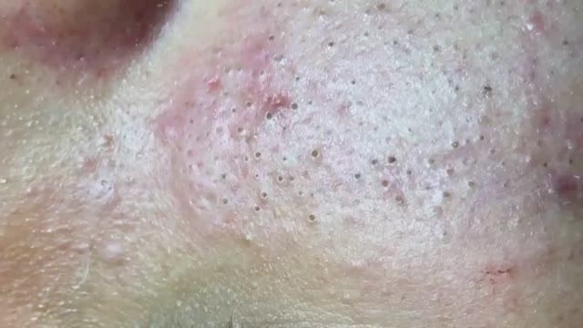 Выдавили черные точки! Море комедонов! смотреть онлайн