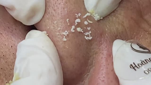 Очистка носа от сальных нитей. #сальныенити #удалениесальныхнитей смотреть онлайн