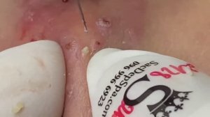 Выдавливание прыщей, угрей, черных точек и камедонов #29