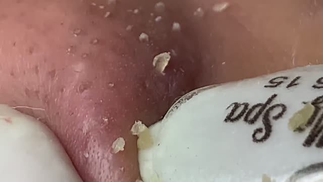 Избавляемся от прыщей на носу всего за 5 минут! смотреть онлайн