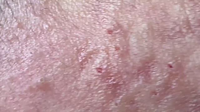 Быстрое избавление от черных точек | How to get rid of blackheads quickly смотреть онлайн