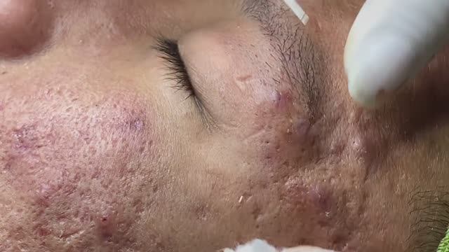 Лечение прыщей в 14 лет. Часть 1: невероятный результат смотреть онлайн