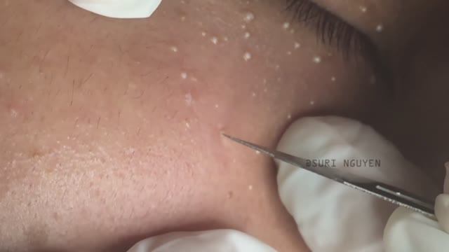 Аккуратное удаление милиумов в периорбитальной зоне: мастер-класс Suri Job 14 смотреть онлайн