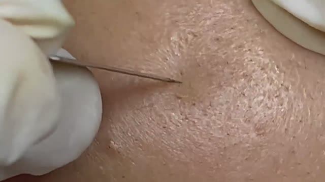 ГЛУБИННАЯ ЧИСТКА! Как достаем черные точки ИЗ-ПОД КОЖИ смотреть онлайн